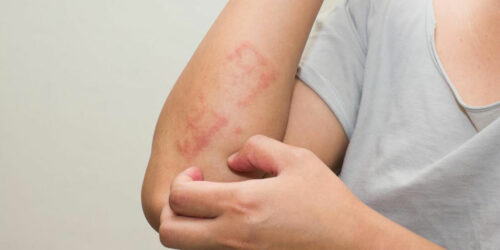 Factors Causing Atopic Dermatitis and Treatments for it