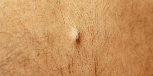 Facts and Signs of Ingrown Hair