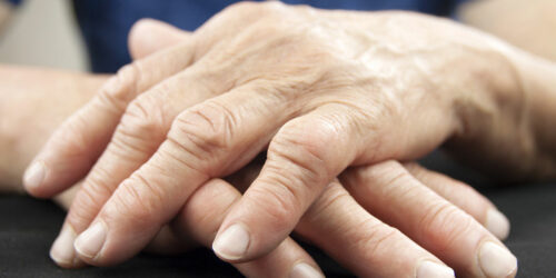 Know about the stages, diagnosis, and prevention of arthritis