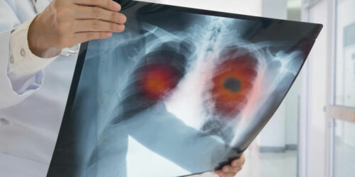 Know the causes, symptoms, and treatment of non-small cell lung cancer