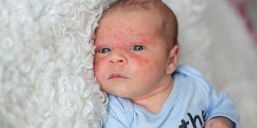 How Baby Eczema Differs With Age and Steroid Treatment