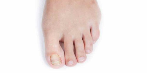 How to Treat Fungal Infections in the Toenails