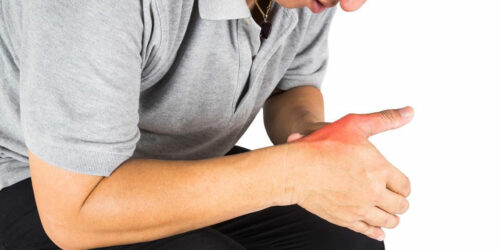 How to Treat Gout Symptoms Effectively