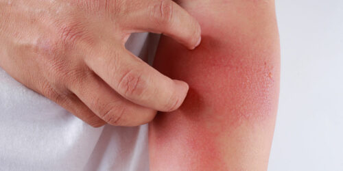 Here&#8217;s How to Identify a Skin Rash