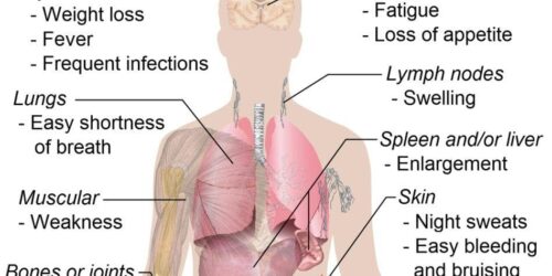 Is your Body Telling You About these Leukaemia Symptoms?