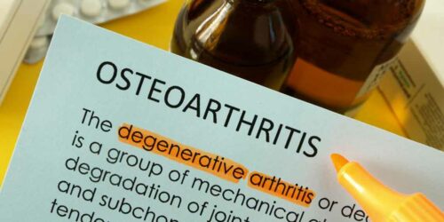 Osteoarthritis: Causes, symptoms, and treatments