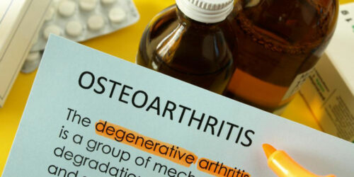 Osteoarthritis &#8211; How to Treat it