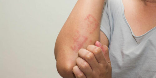 Lupus Skin Rash &#8211; Symptoms and Treatment