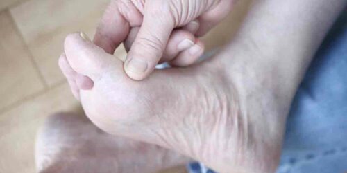 Managing Gout Foot Pain Effectively