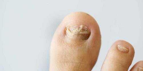 Some tips on how to cure nail fungus