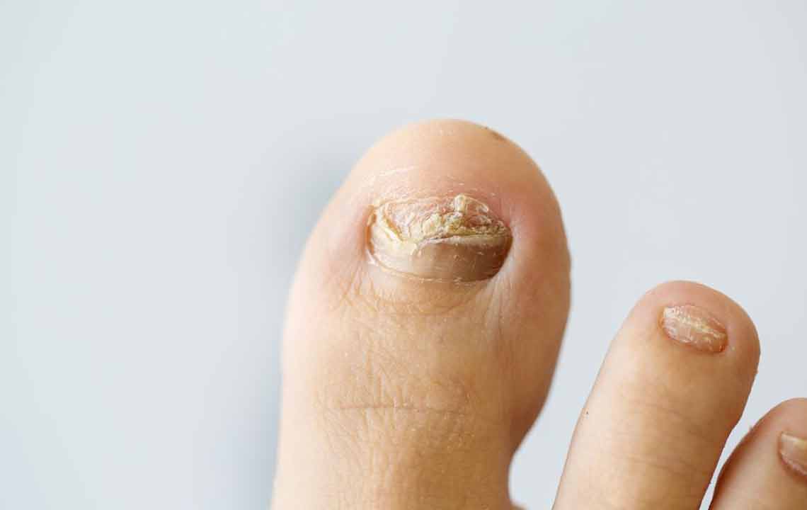 Some tips on how to cure nail fungus