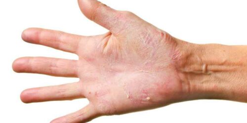 Six creams that can cure eczema