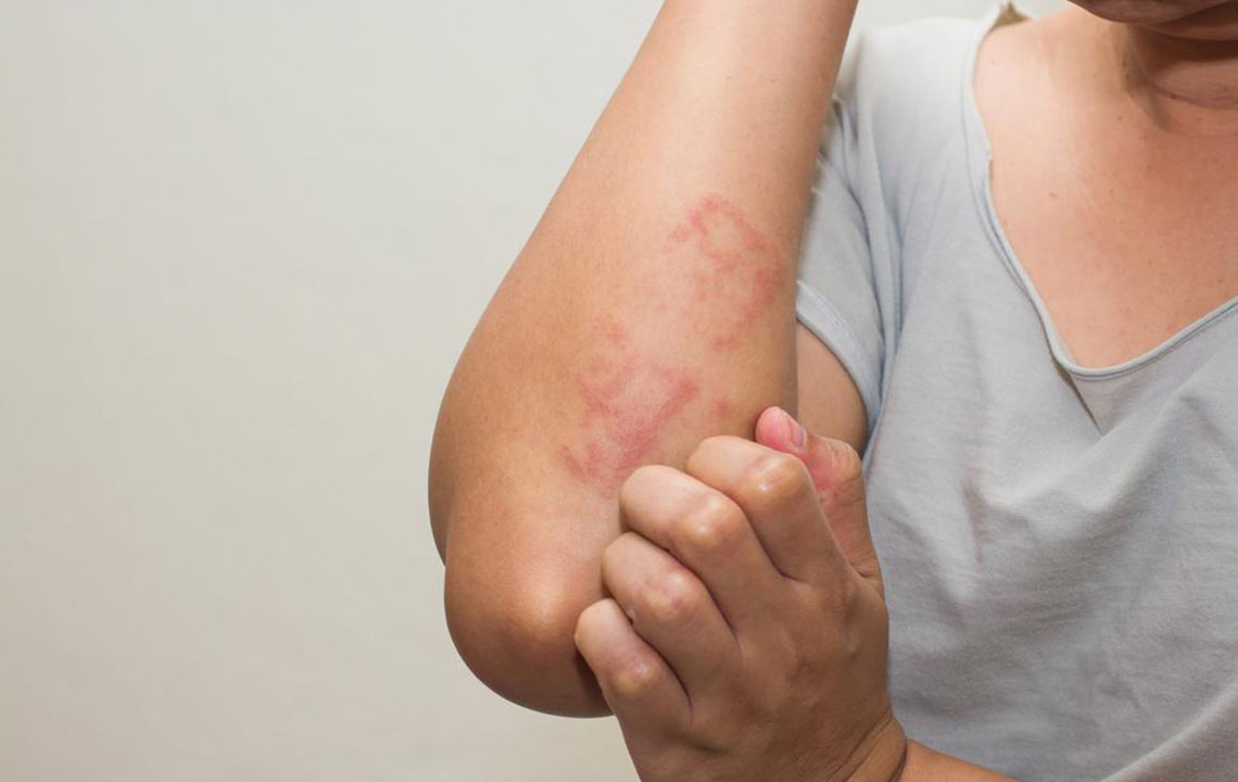 Signs and Symptoms of Lupus You Need to Be Aware Of