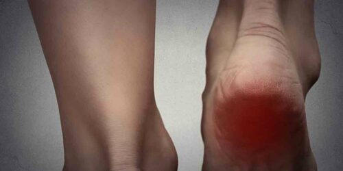 Simple Treatment Options for Gout