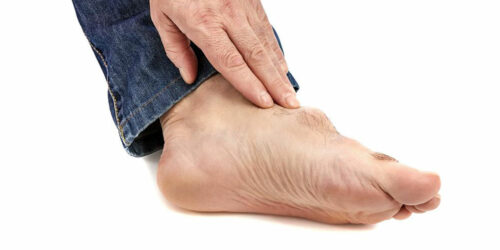 Symptoms, Causes, and Treatment of Gout