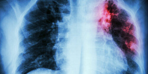 Symptoms and Diagnosis of a Pulmonary Embolism