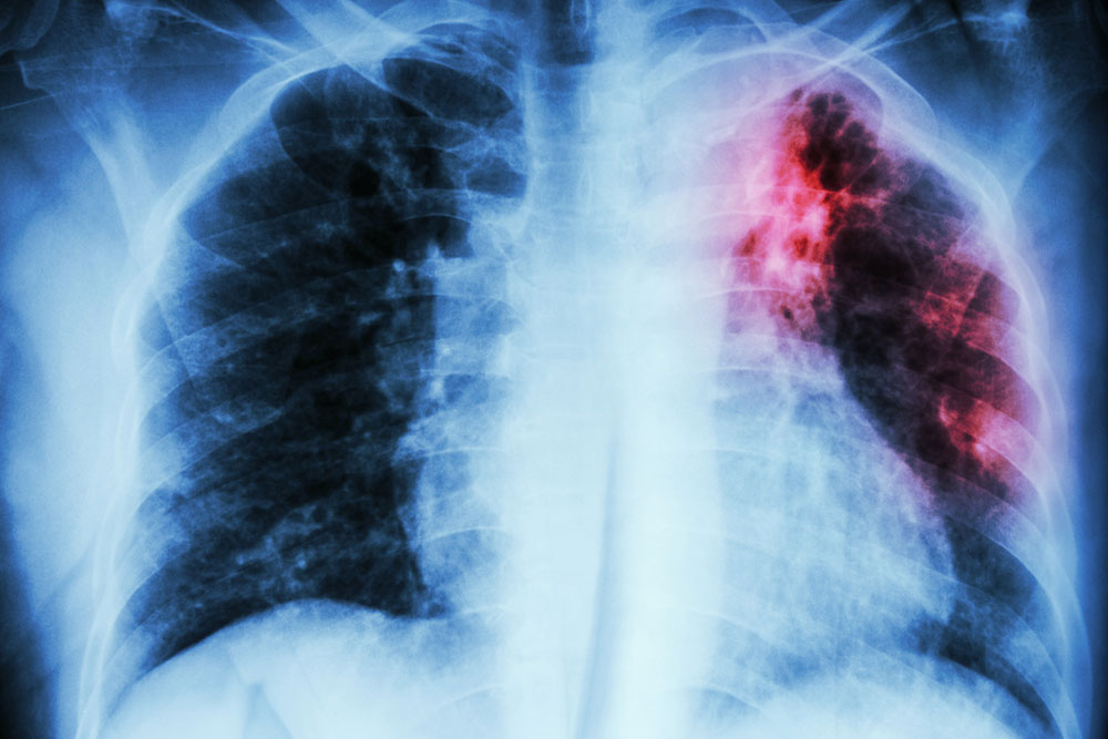 Symptoms and Diagnosis of a Pulmonary Embolism