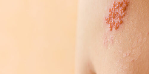 Symptoms and causes of shingles