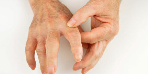 Popular Treatment Options for Rheumatoid Arthritis and Gout