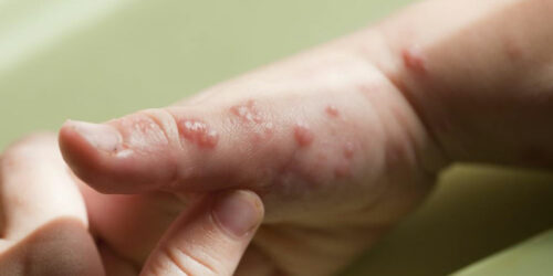 Popular Treatment Options for Shingles