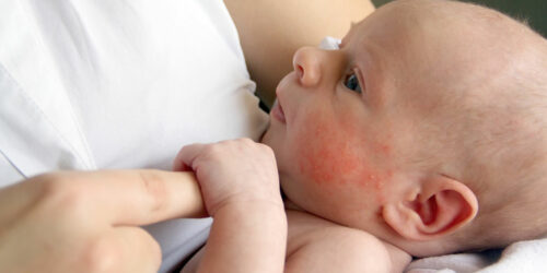 Prevent these infant skin issues to keep your baby’s skin flawless