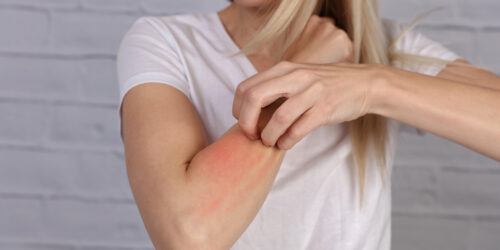 Psoriasis Medications And Their Side Effects