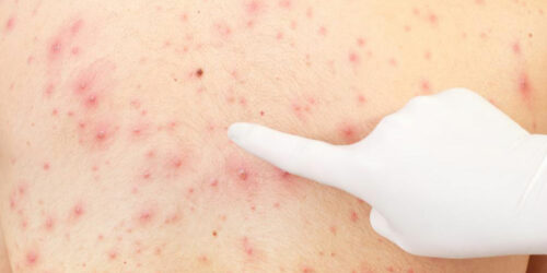 Remedies to Treat Keratosis Pilaris at Home