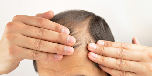 Ways to manage hair loss