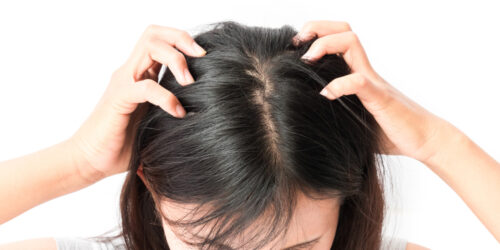 What To Know About Treating An Itchy Scalp