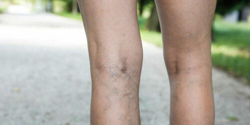 What You Need to Know about Deep Vein Thrombosis