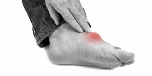 What You Need to Know about Gout