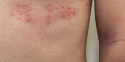 Top 3 Simple Treatments for Shingles You Need to Know