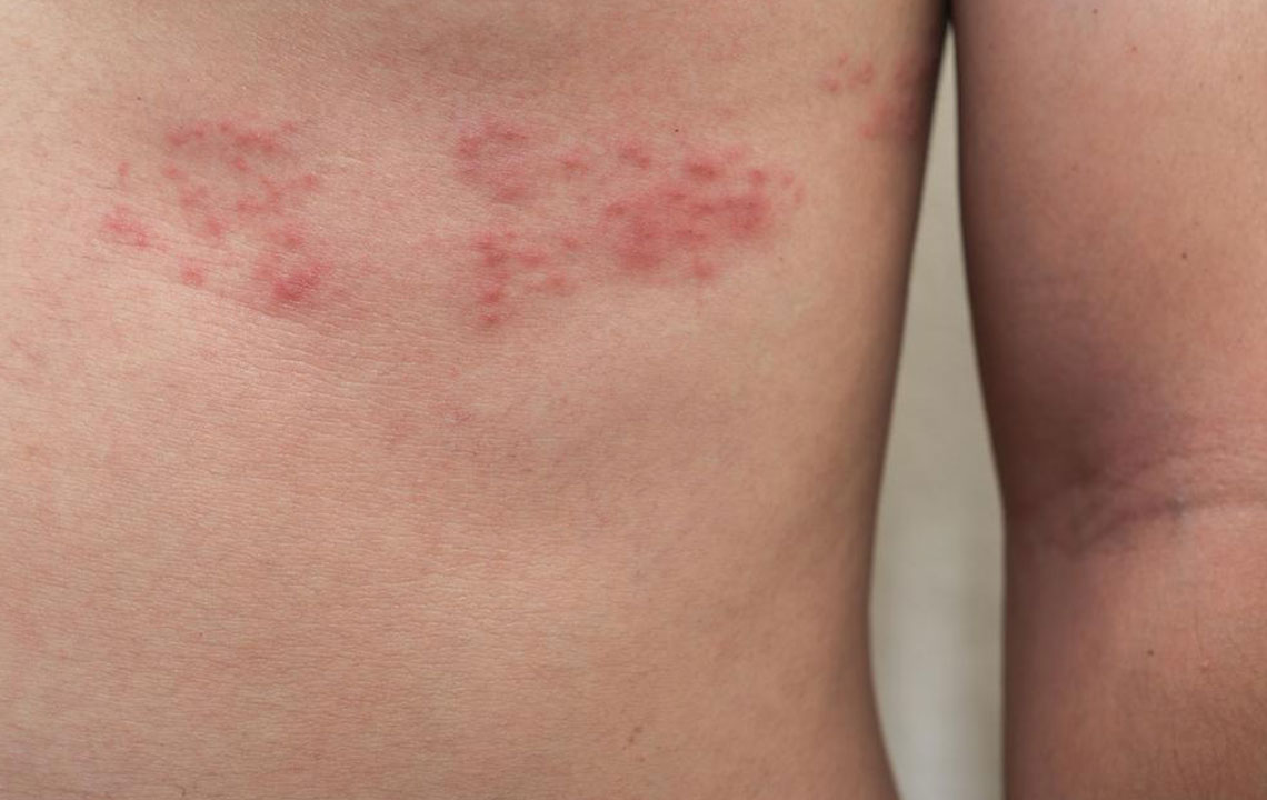 Top 3 Simple Treatments for Shingles You Need to Know