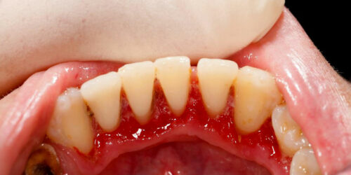 Top 8 natural treatments for gum disease