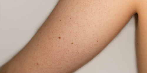 Top Treatment Options for Keratosis Pilaris