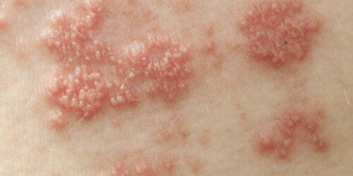 The Treatments for Shingles You Should Know