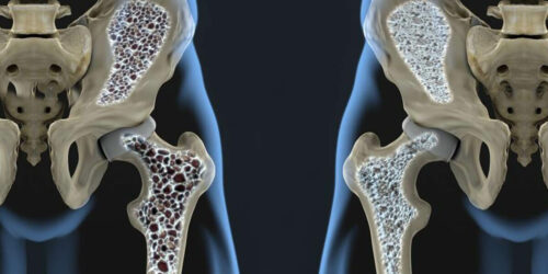 These Common Medical Conditions are Causing Your Osteoporosis Bone Loss