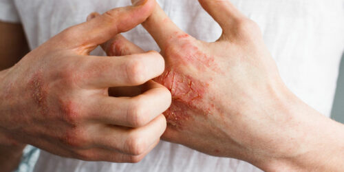 Things You Need to Know about Eczema