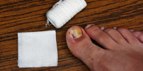 Tips to Cure and Prevent Toenail Fungus