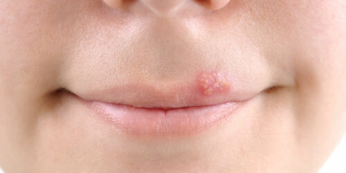 Tips to Treat Cold Sores Effectually