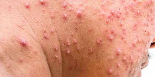 Tips to Treat Shingles Rash