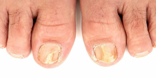 Try These 5 Ways to Effectively Treat Toenail Fungus