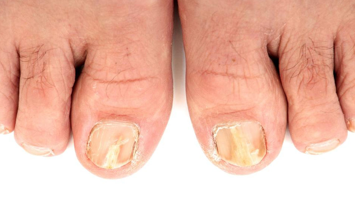 Try These 5 Ways to Effectively Treat Toenail Fungus