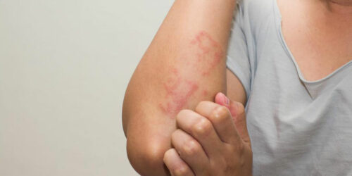 Treatment Options for Eczema You Should Know About