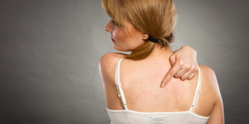 Treatment Procedures And Home Remedies For Eczema