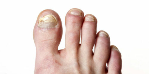 Tried and Tested Natural Cure for Toenail Fungus