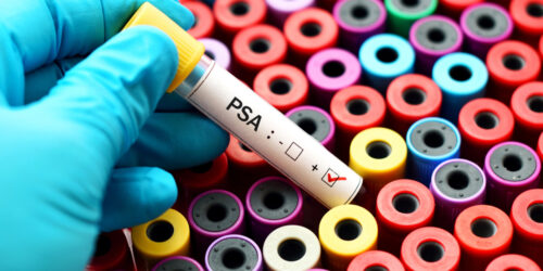 Understanding The Causes Of High Psa Levels