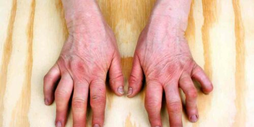 Understanding the Symptoms of Rheumatoid Arthritis