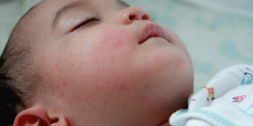 Understanding the Signs and Symptoms of Baby Eczema