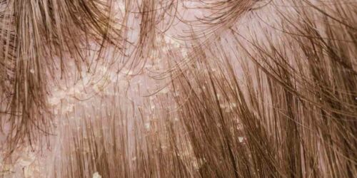 Useful Mild Treatment Solutions for Scalp Psoriasis Problem